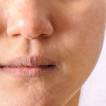 what std causes dry skin on face