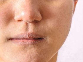 what std causes dry skin on face