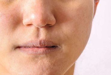 what std causes dry skin on face