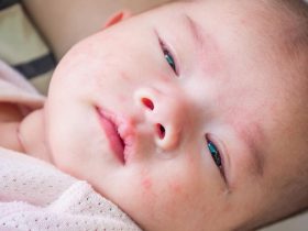 newborn dry skin