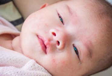newborn dry skin