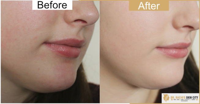 Skin Whitening Laser Treatment