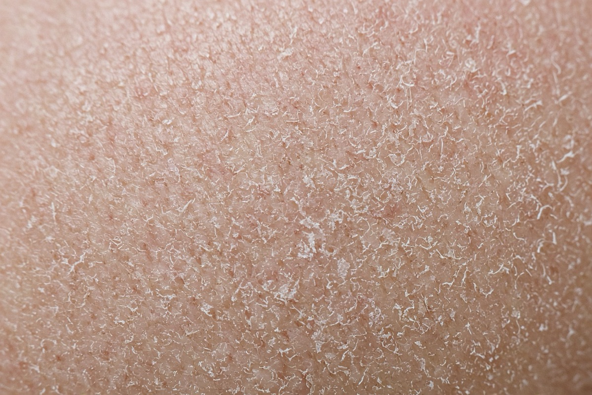 Close-up of cheek showing dry flaky skin on face with small dry patches